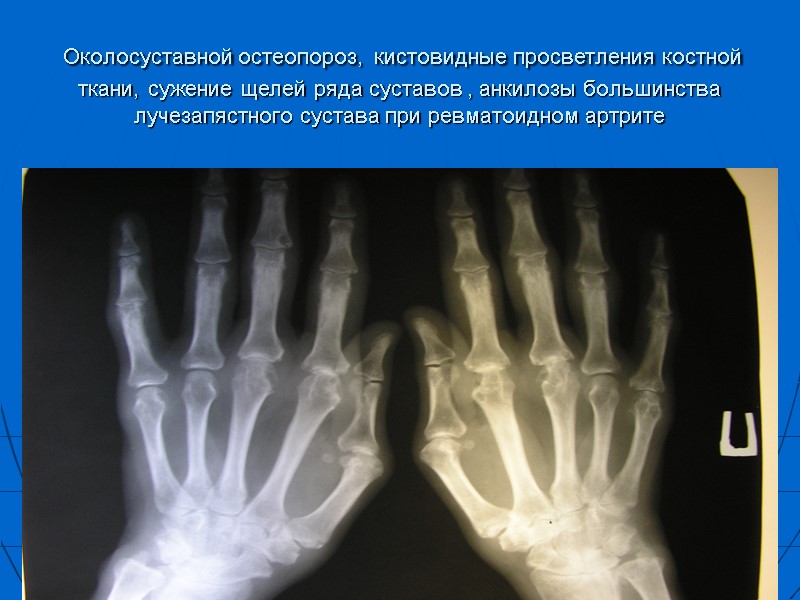 Околосуставной остеопороз, кистовидные просветления костной ткани, сужение щелей ряда суставов , анкилозы большинства лучезапястного